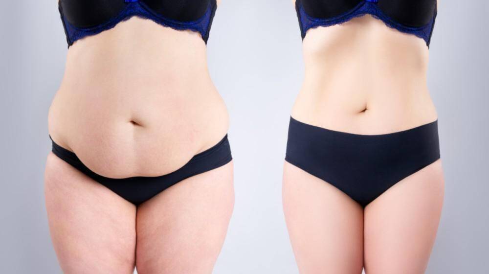 Tummy Tuck before/after