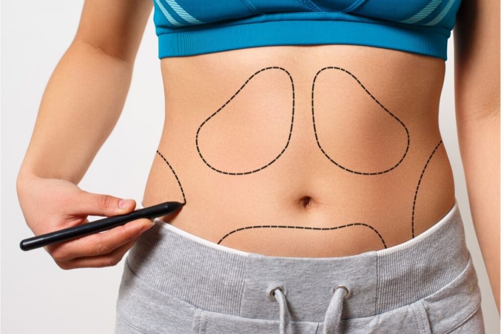 Performing of a liposuction
