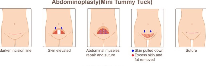 abdominoplasty mini-tummy-tuck