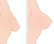 breast-lift-before-after