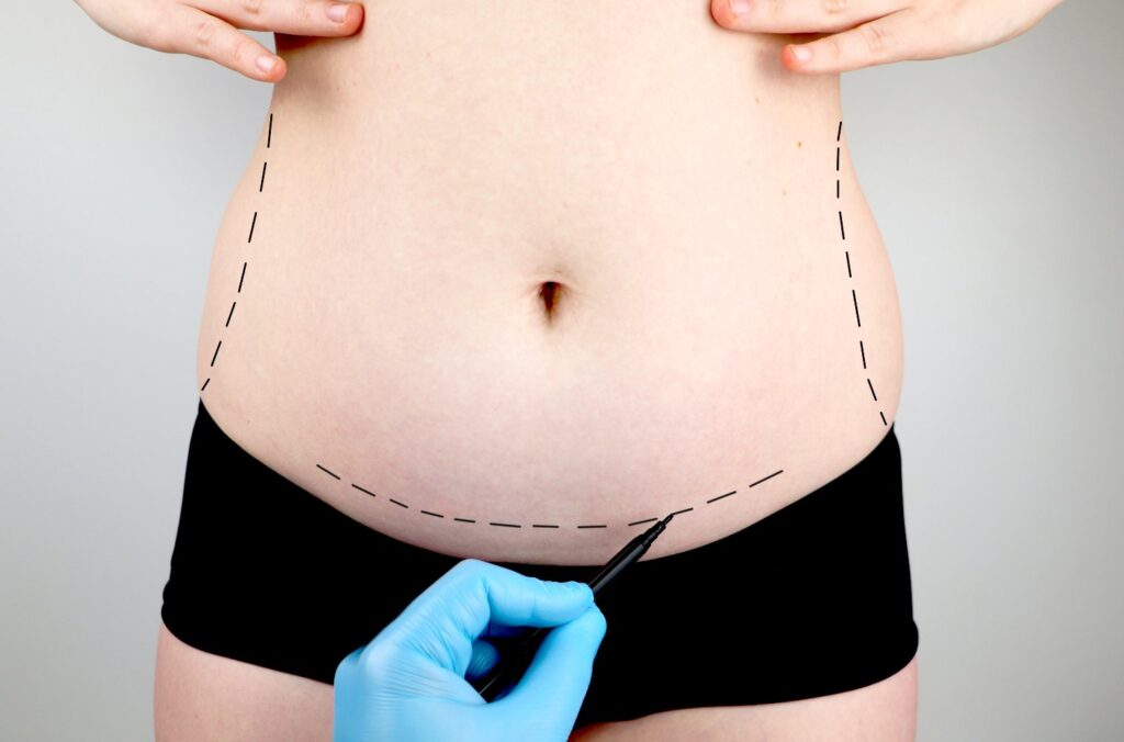 Full abdominoplasty