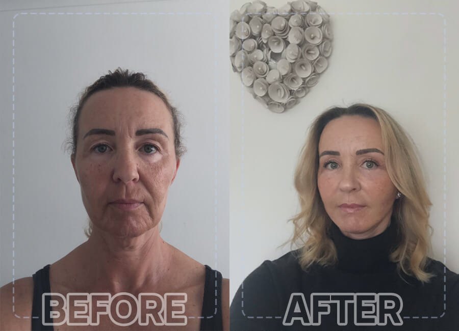 face lift before after patient 2