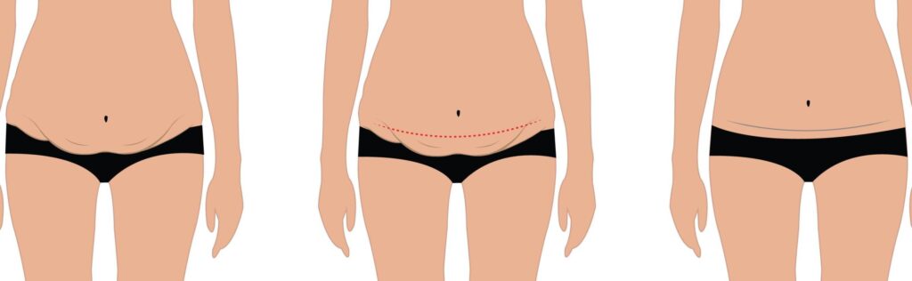 tummy tuck procrdure