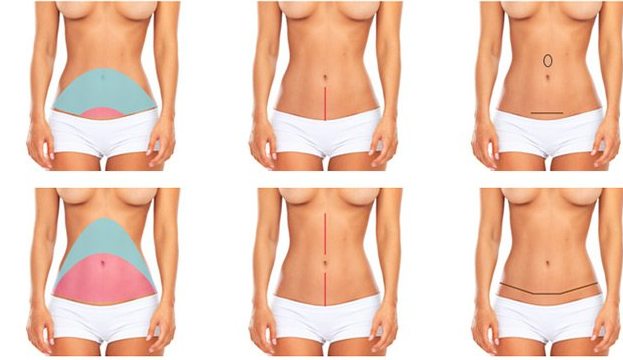 tummy_tuck_diagram