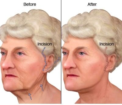 face lift process