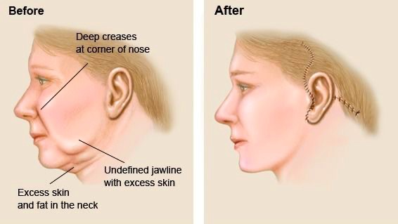 face lift process 2