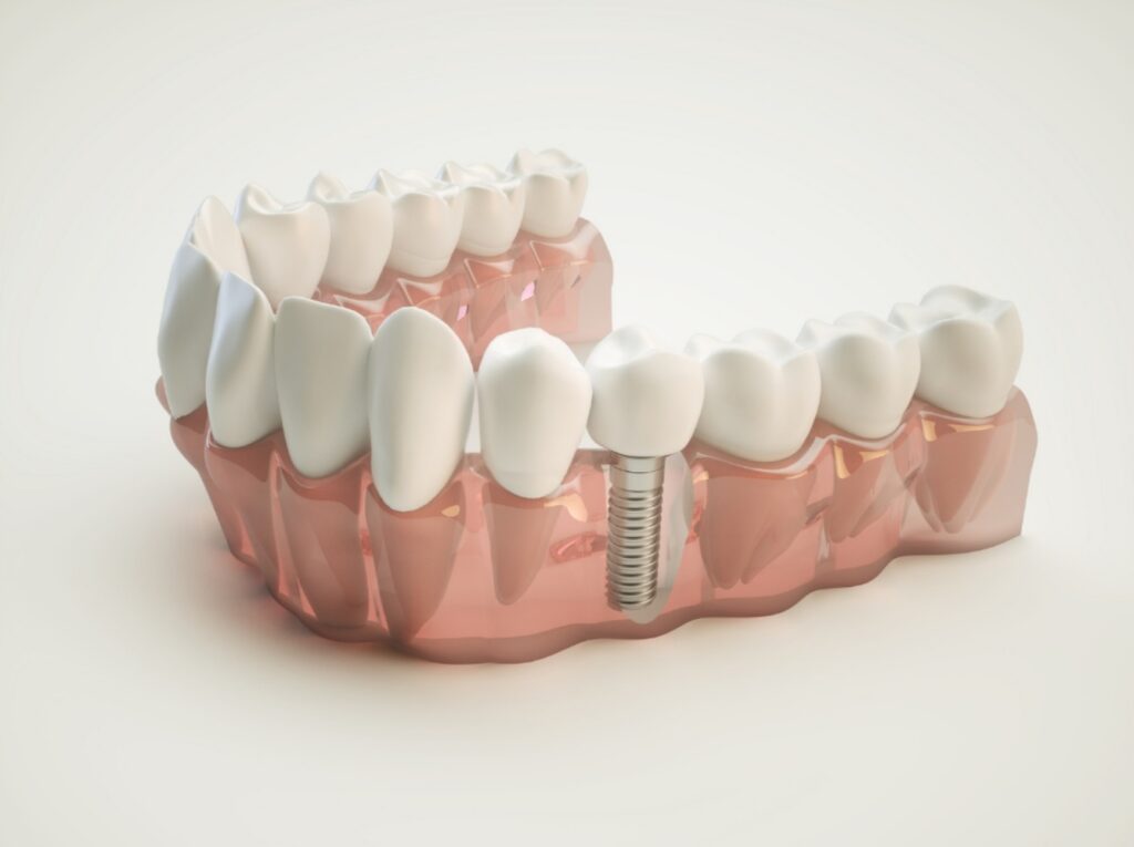 Dental implants