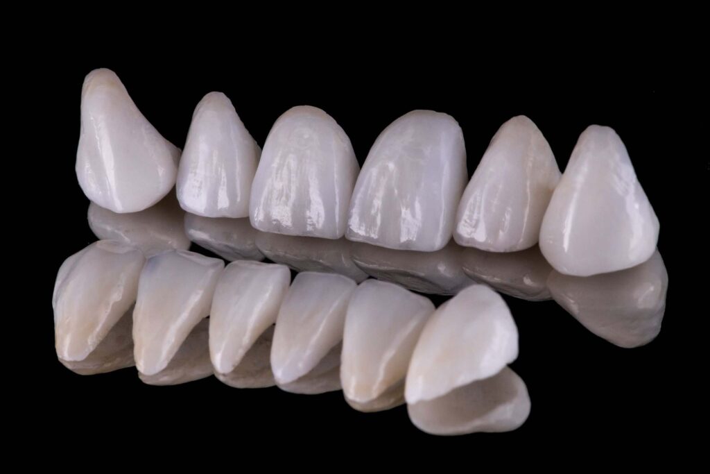 Porcelain veneers