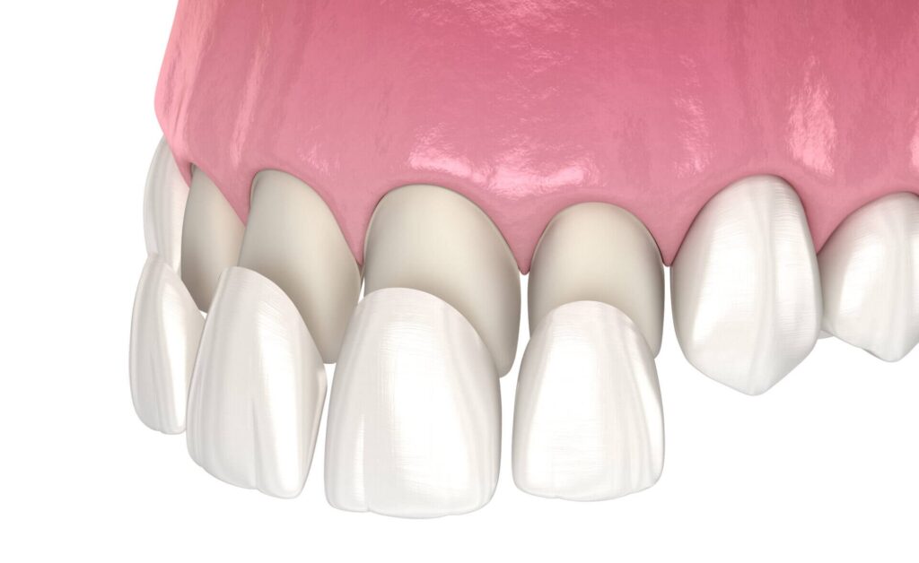 veneers 17278