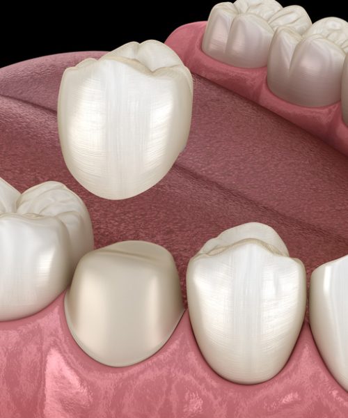 Preparated premolar tooth for dental crown placement. Medically accurate 3D illustration