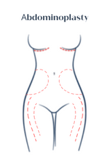Аbdominoplasty