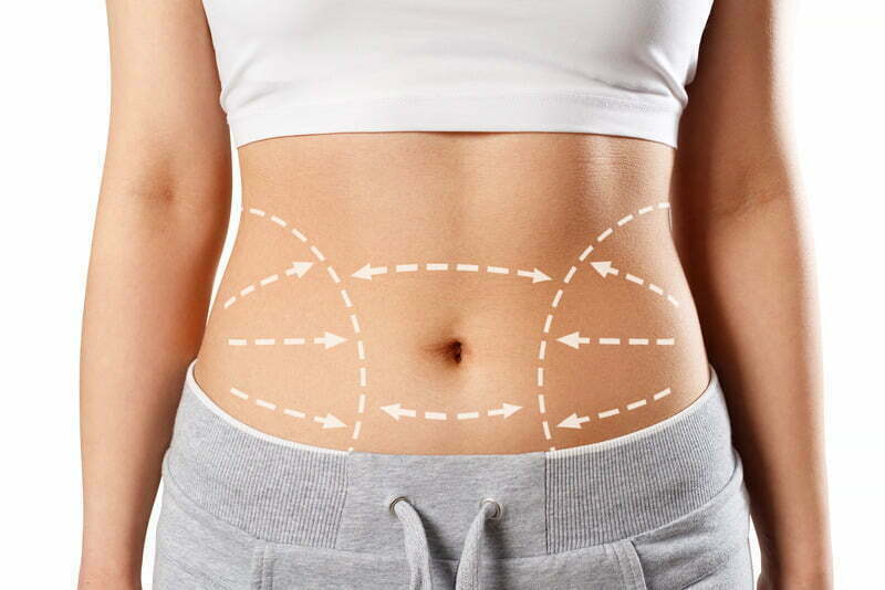 Tummy tuck